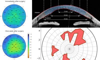 Corneal Transplantation Surgery AI For An Eye Healthcare In Europe