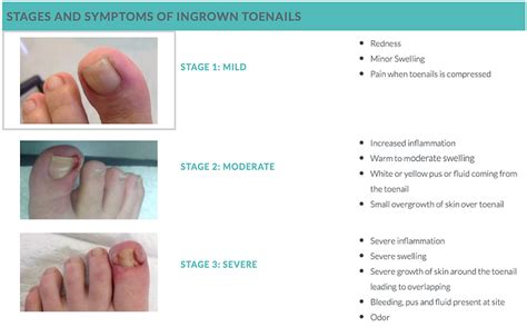 Ingrown Nail Surgery Footmed Podiatry