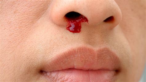 Bleeding Nose