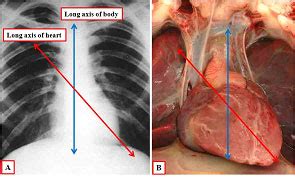 Heart Anatomy In Chest - Anatomical Charts & Posters