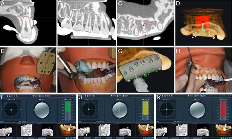 Accuracy And Efficiency Of Endodontic Microsurgery Assisted By Dynamic Navigation Based On Two