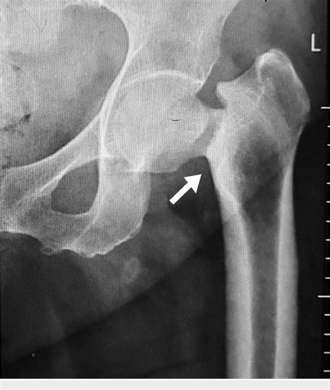 Figure From Bilateral Femoral Neck Stress Fracture In An Obese Middle