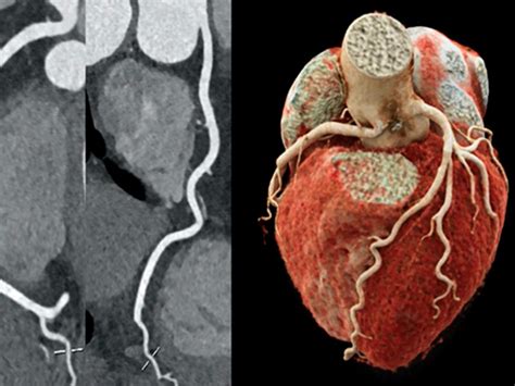 Angiotomografia das Artérias Coronárias Imagem