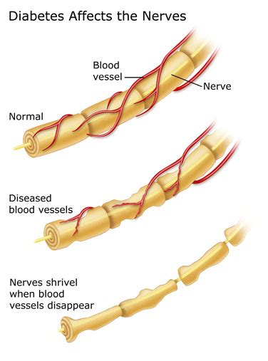 Nerve Complications Diabetes Education Online