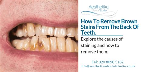 How To Remove Brown Stains From The Back Of Teeth