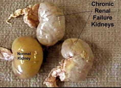 Chronic Renal Failure | Renal Treatment Centers