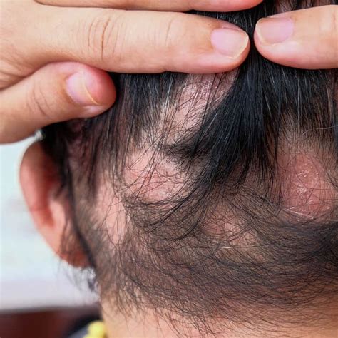 Anti Hair Loss Treatment In Singapore Alopecia Treatment Price