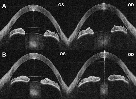 Averaged Oct B Scan Images Acquired Using The Binocular Oct Prototype