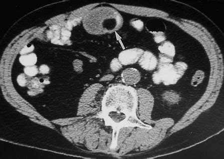 Small Bowel Intussusception Caused By A Lipoma As A Lead Point Same