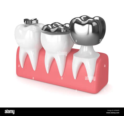 D Render Of Teeth With Inlay Onlay And Crown Amalgam Filling Over