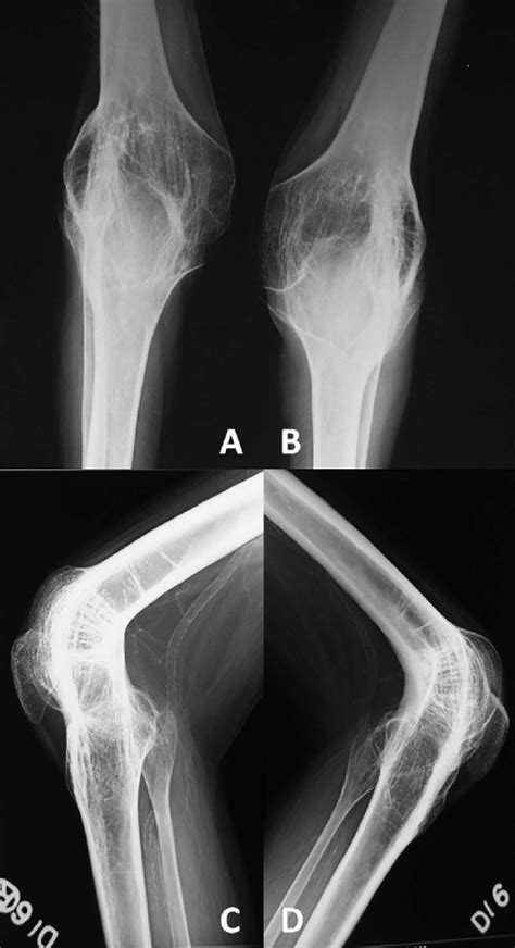 Plain Radiographs Of Both Knee Joints Anteroposterior A And B And Download Scientific Diagram