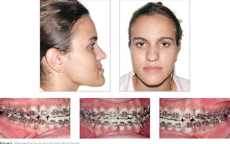 Figure 5 From Surgical Treatment Of Dental And Skeletal Class Iii Malocclusion Semantic Scholar