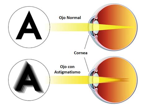 Tipos De Astigmatismo Mi Pico Hipermetr Pico Y Mixto Optometristas Org