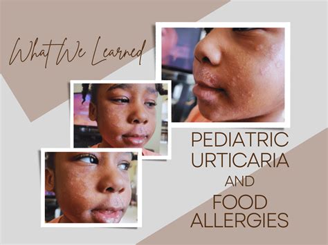 What we learned about Pediatric Urticaria (hives) and Food Allergies