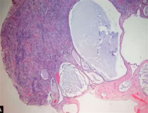 Lecture 129 Pathology Of The Female Reproductive Tract Part 1