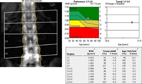 Bone Density Test Results Explained About Osteoporosis