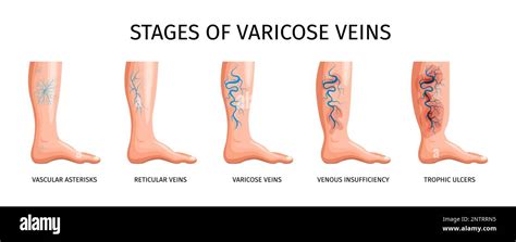 Stages Of Varicose Veins So As Vascular Asterisks Reticular Veins Venous Insufficiency Trophic