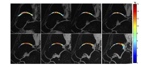 Rapid Volumetric Quantification Of Cartilage Biochemistry With Mri