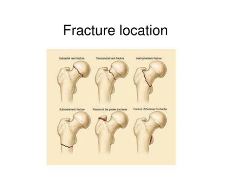 Subcapital Femoral Neck Fracture