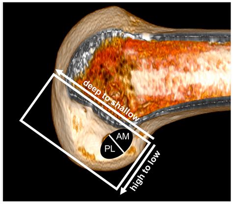 Medicina Free Full Text Usefulness Of 3 Dimensional Computed Tomography Assessment Of