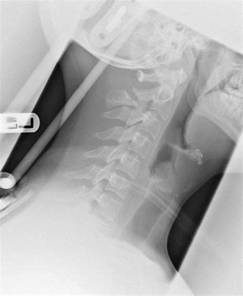 fracture hangman – RCEMLearning India