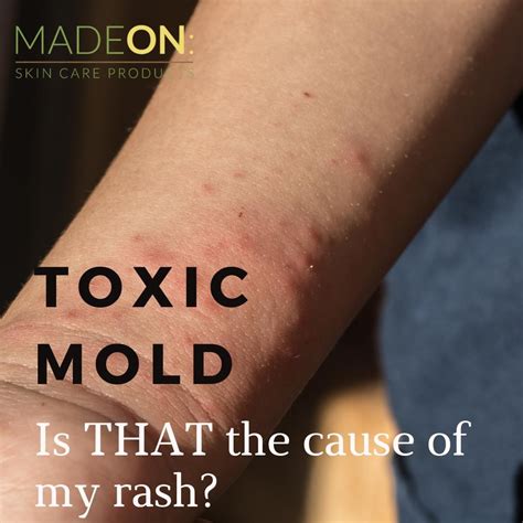 Symptoms Of Toxic Mold Exposure MadeOn Skin Care