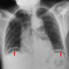 Free air under the diaphragm in chest X-ray | Download Scientific Diagram