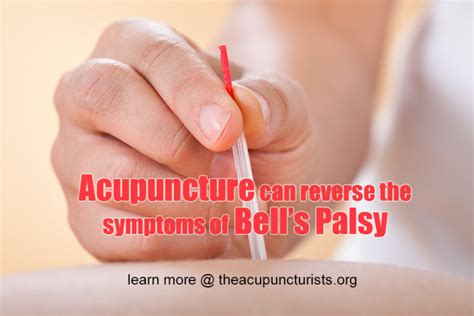 Acupuncture And Bells Palsy Coral Springs Coconut Creek