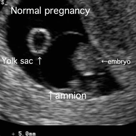 Blighted ovum: Cause, symptoms, ultrasound, treatment, prevention etc ...