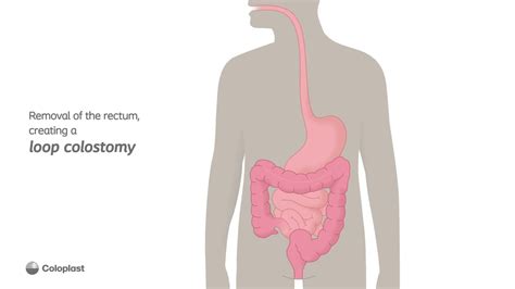 Creation Of Loop Colostomy By Removing The Rectum Ostomy Surgery