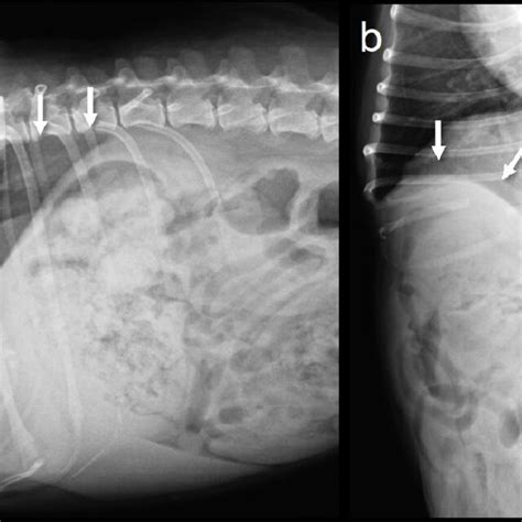 Abdominal Radiographs At The 6 Month Follow Up The Suture Line Of The