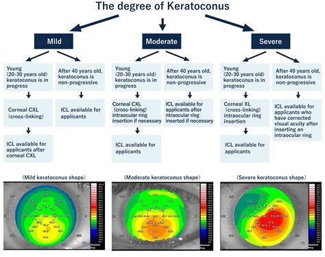 Keratoconus Eye Clinic Tokyo En