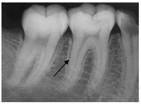 Anquilosis Dental Qu Es Y C Mo Tratarla