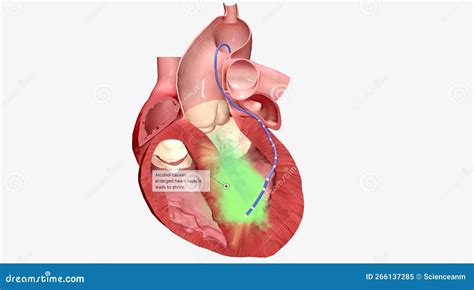 In Alcohol Septal Ablation A Small Amount Of Pure Alcohol Is Released