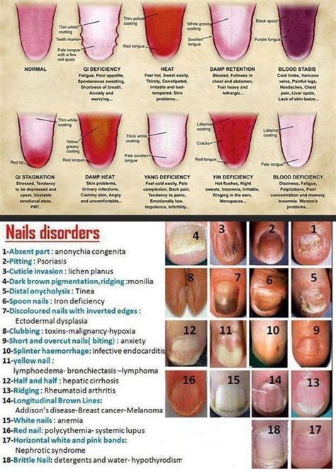 Tongue And Nails As Indications Of Health Nail Diseases And