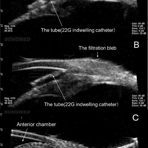 A Ultrasound Biomicroscopy Before Bleb Perforation B Fourteen Days