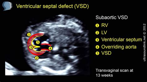 Fetal Echo Types Of Ventricular Septal Defects Sujyotheartclinic Hot Sex Picture