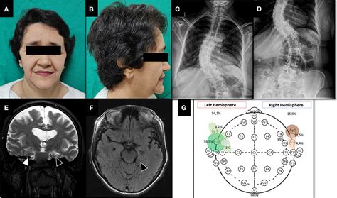 Frontiers Case Report Successful Anterior Temporal Lobectomy In Drug