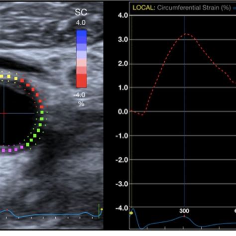 Non Invasive Ultrasound A Transcranial Doppler Tcd Bubble Test