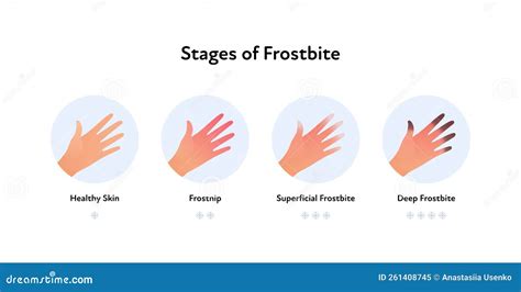 Frostbite Anatomical Infographic Poster. Vector Flat Medical Illustration. Stages of Hypotermia ...