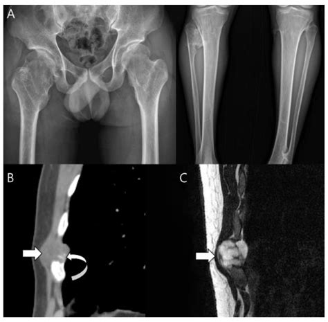 Cancers Free Full Text Classification Of Chondrosarcoma From