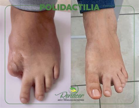 Polidactilia Protesis Renacer Protesis Renacer Fabricaci N De