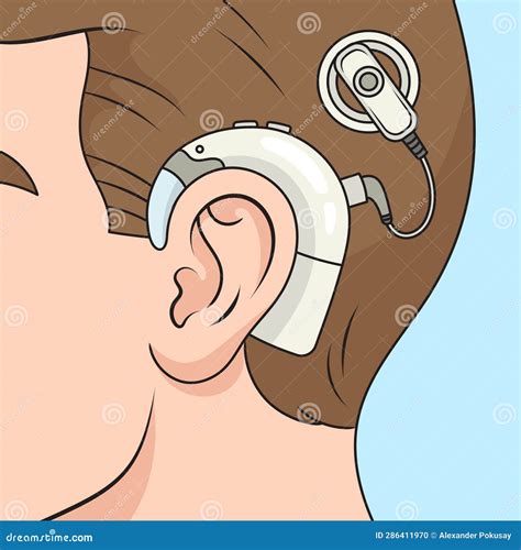 Cochlear Implant Diagram Medical Science Stock Illustration Illustration Of Poster Structure