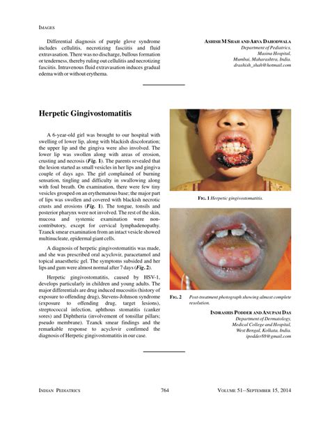 (PDF) Herpetic Gingivostomatitis