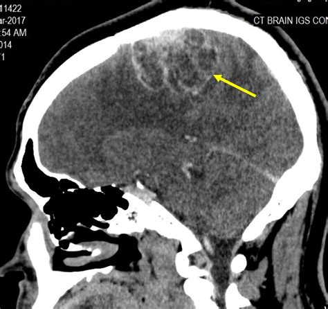 Microcystic meningioma – Radiology Cases