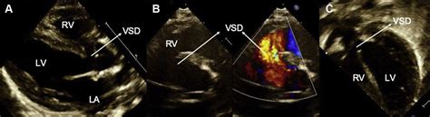 Evolution Of Interventricular Septal Hematoma Echocardiographic