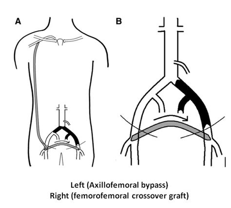 Bypass Surgery Nq Vascular Services Townsville And Mackay