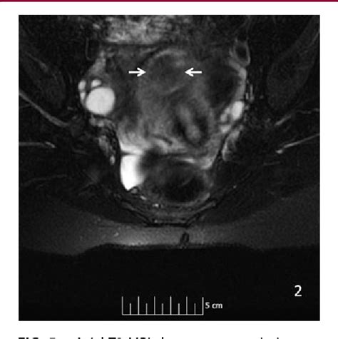 Figure 1 From Diagnosis And Management Of An Adenomatoid Uterine Tumor