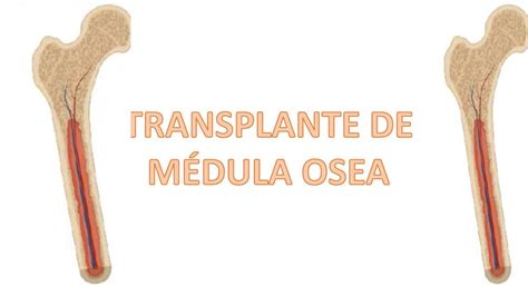 Trasplante de médula ósea | Katya Turco vila | uDocz