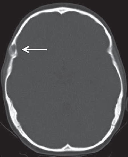 Figure 1 From Intradiploic Dermoid Cyst Of The Lateral Frontotemporal